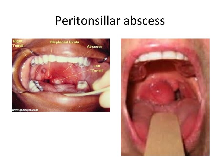Peritonsillar abscess 