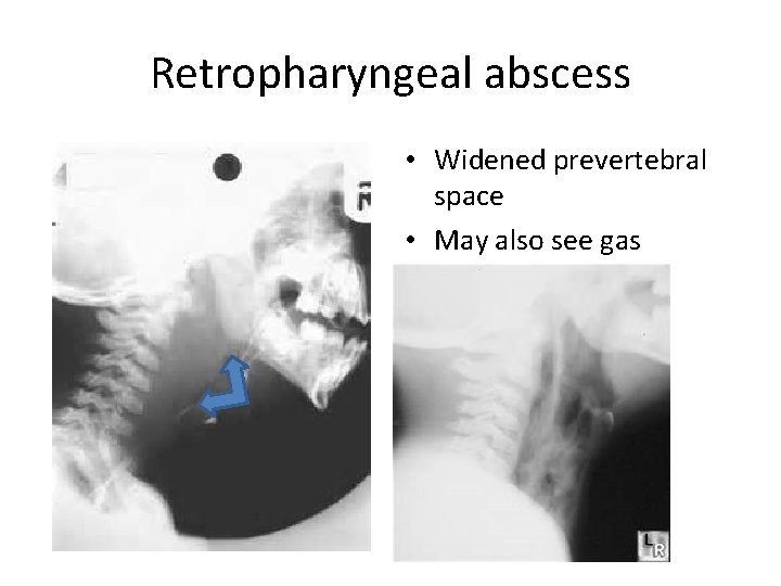 Retropharyngeal abscess • Widened prevertebral space • May also see gas 