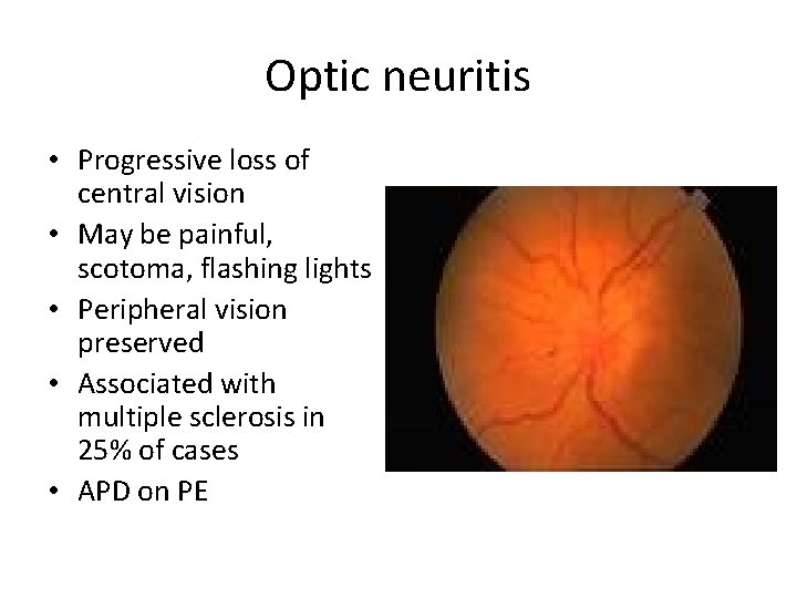 Optic neuritis • Progressive loss of central vision • May be painful, scotoma, flashing