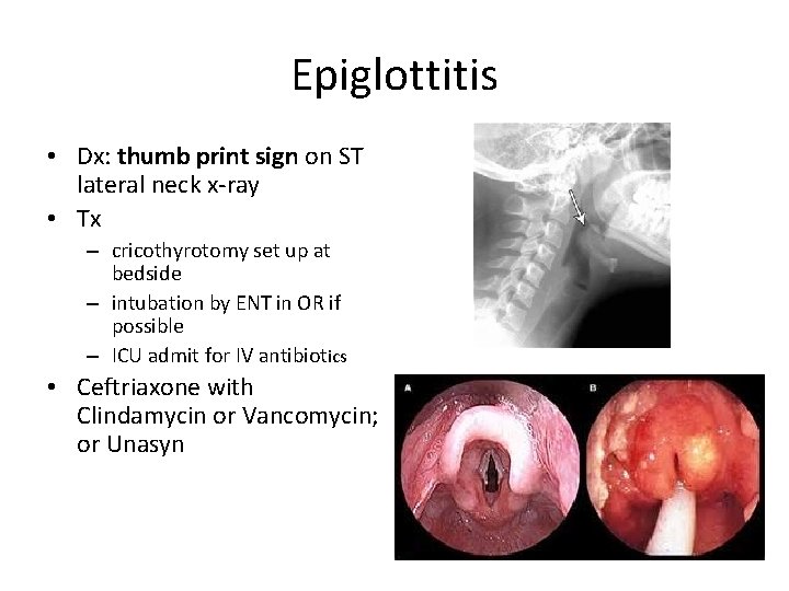 Epiglottitis • Dx: thumb print sign on ST lateral neck x-ray • Tx –