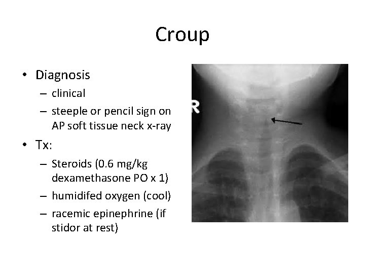 Croup • Diagnosis – clinical – steeple or pencil sign on AP soft tissue