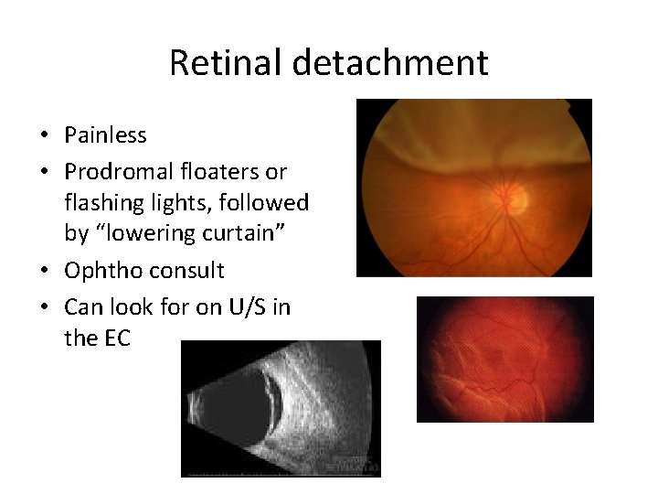 Retinal detachment • Painless • Prodromal floaters or flashing lights, followed by “lowering curtain”