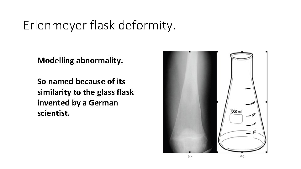 Erlenmeyer flask deformity. Modelling abnormality. So named because of its similarity to the glass