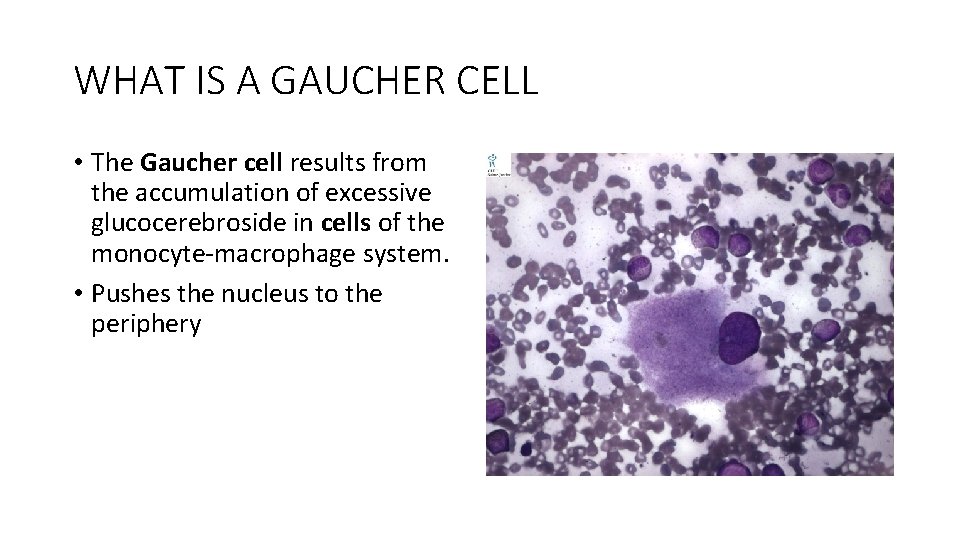 WHAT IS A GAUCHER CELL • The Gaucher cell results from the accumulation of