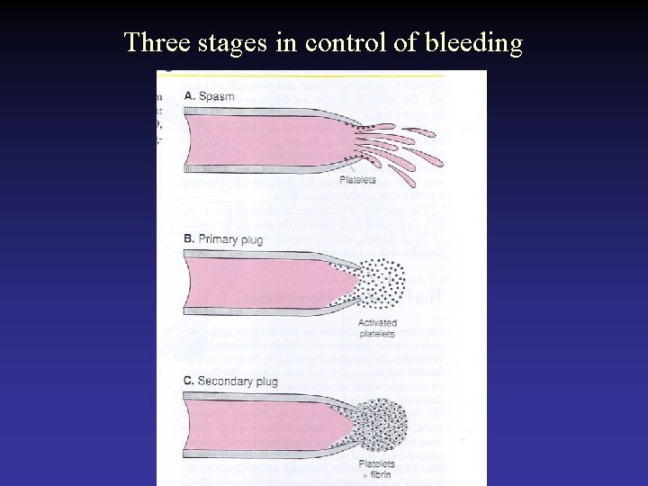 Three stages in control of bleeding 