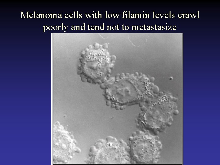 Melanoma cells with low filamin levels crawl poorly and tend not to metastasize 