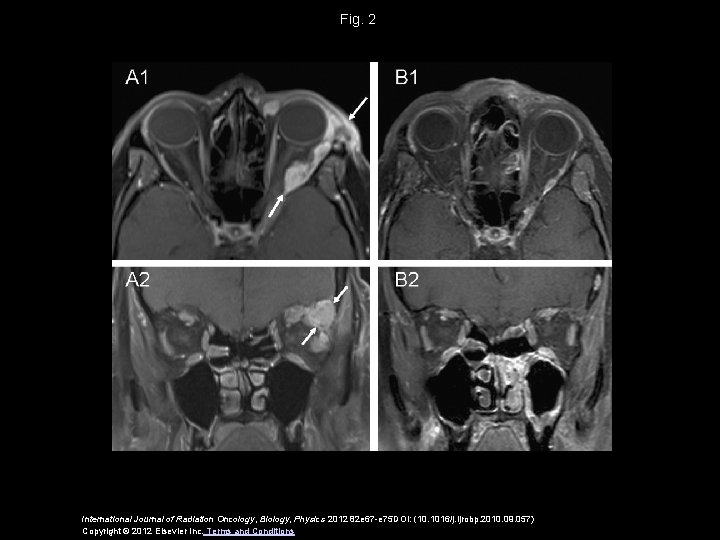 Fig. 2 International Journal of Radiation Oncology, Biology, Physics 2012 82 e 67 -e