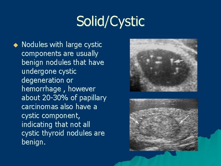 Solid/Cystic u Nodules with large cystic components are usually benign nodules that have undergone