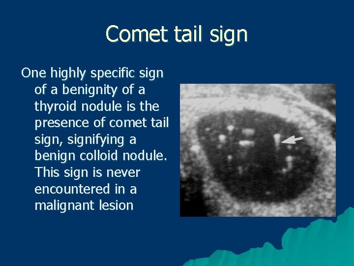 Comet tail sign One highly specific sign of a benignity of a thyroid nodule