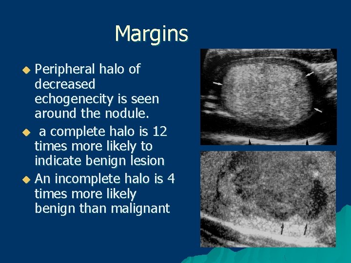 Margins Peripheral halo of decreased echogenecity is seen around the nodule. u a complete