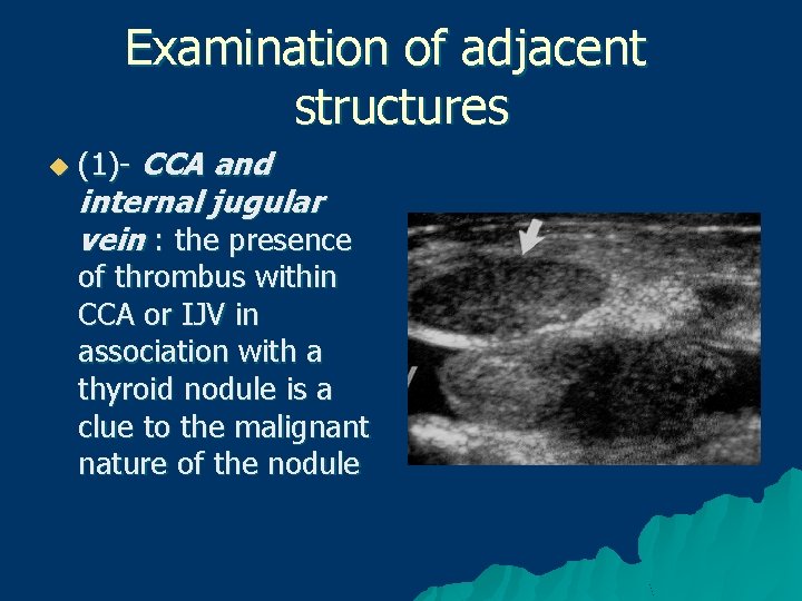 Examination of adjacent structures u (1)- CCA and internal jugular vein : the presence