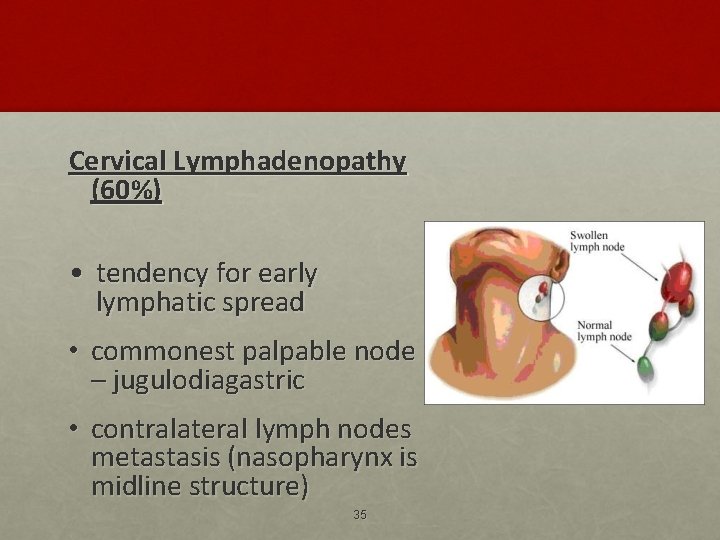 Cervical Lymphadenopathy (60%) • tendency for early lymphatic spread • commonest palpable node –