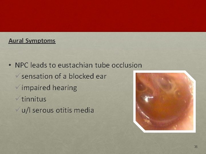 Aural Symptoms • NPC leads to eustachian tube occlusion ü sensation of a blocked