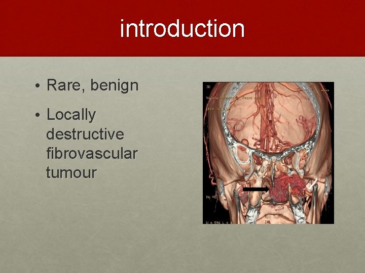 introduction • Rare, benign • Locally destructive fibrovascular tumour 