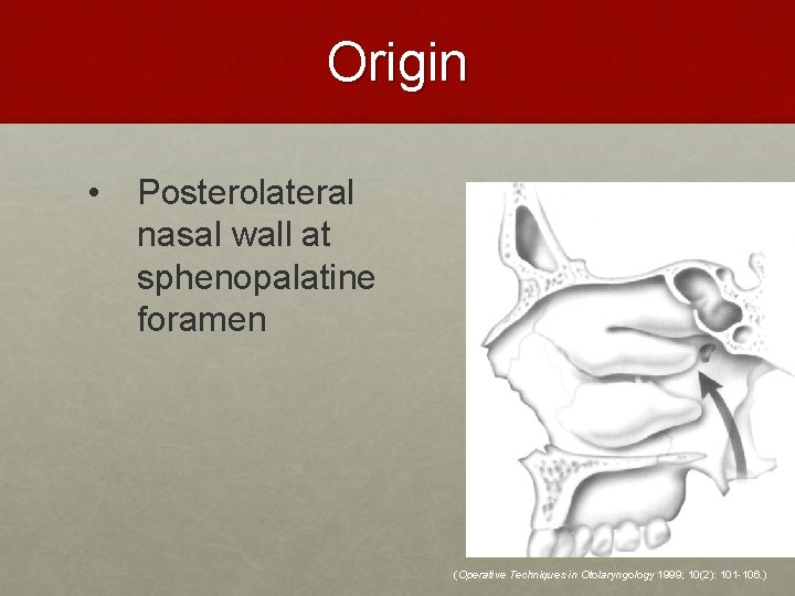 Origin • Posterolateral nasal wall at sphenopalatine foramen (Operative Techniques in Otolaryngology 1999; 10(2):