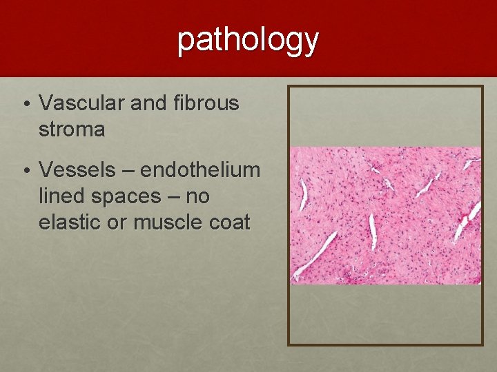 pathology • Vascular and fibrous stroma • Vessels – endothelium lined spaces – no