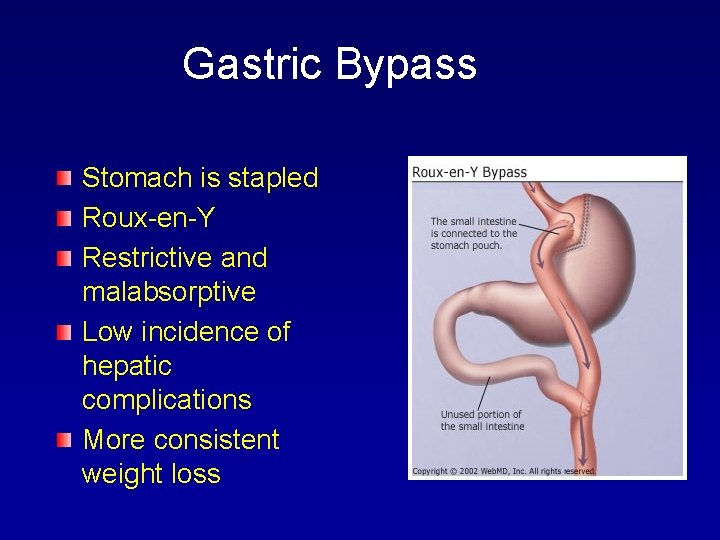 Gastric Bypass Stomach is stapled Roux-en-Y Restrictive and malabsorptive Low incidence of hepatic complications