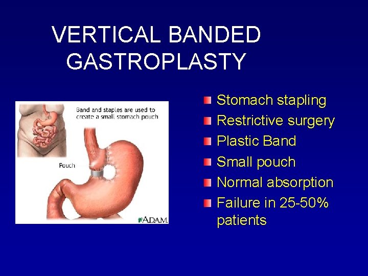 VERTICAL BANDED GASTROPLASTY Stomach stapling Restrictive surgery Plastic Band Small pouch Normal absorption Failure