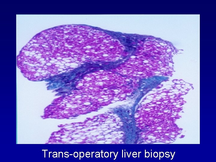 Trans-operatory liver biopsy 