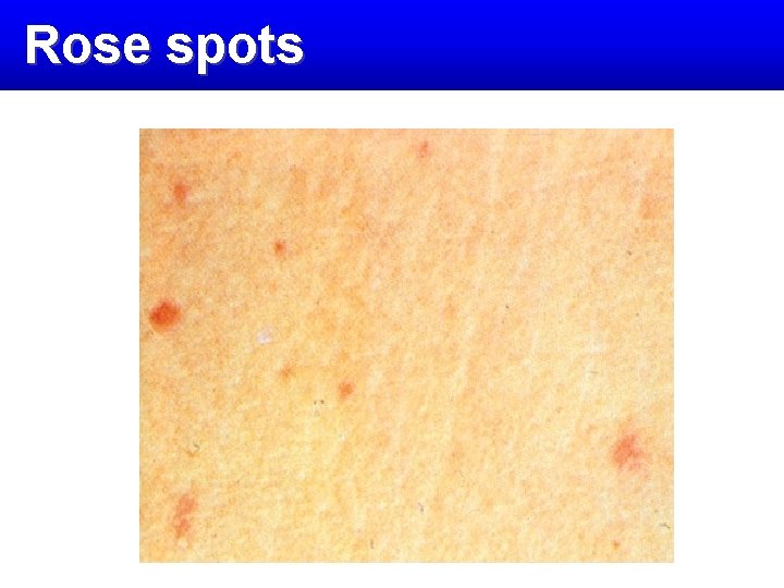 Rose spots 