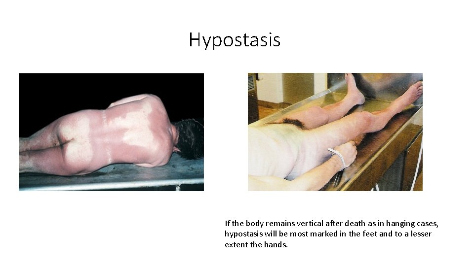 Hypostasis If the body remains vertical after death as in hanging cases, hypostasis will