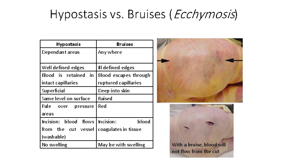 Hypostasis vs. Bruises (Ecchymosis) Hypostasis Dependant areas Bruises Any where Well defined edges Blood