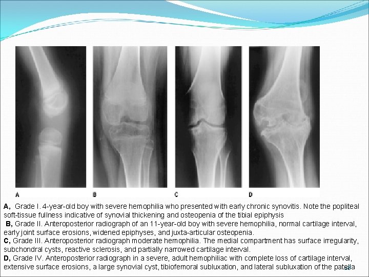 A, Grade I. 4 -year-old boy with severe hemophilia who presented with early chronic