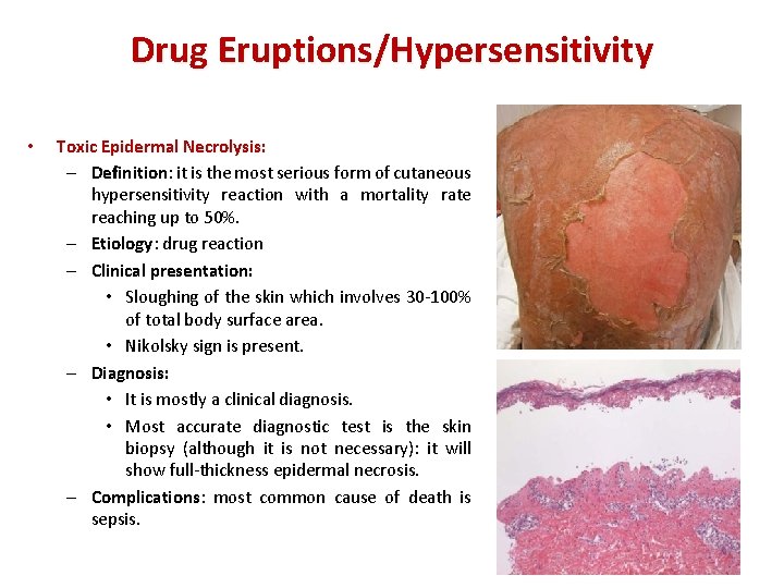 Drug Eruptions/Hypersensitivity • Toxic Epidermal Necrolysis: – Definition: it is the most serious form