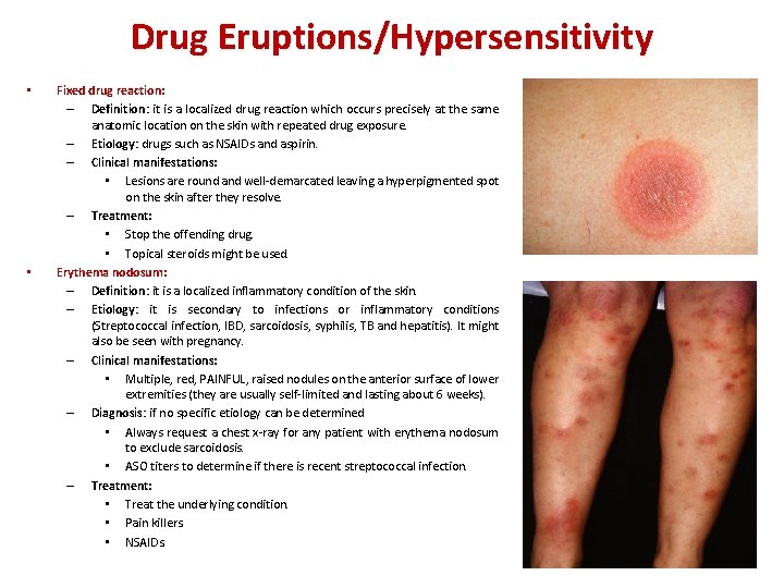 Drug Eruptions/Hypersensitivity • • Fixed drug reaction: – Definition: it is a localized drug