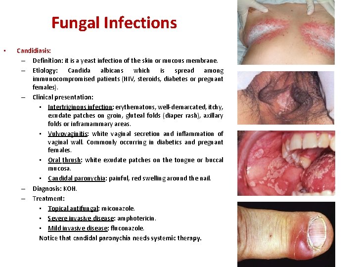 Fungal Infections • Candidiasis: – Definition: it is a yeast infection of the skin