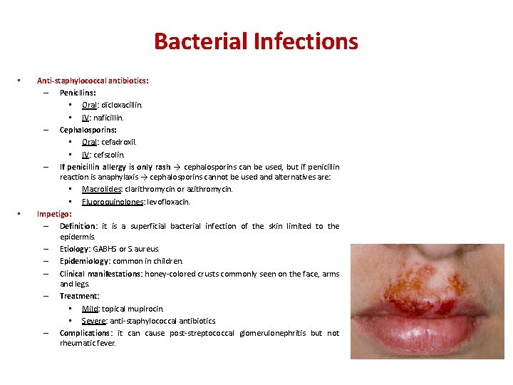 Bacterial Infections • • Anti-staphylococcal antibiotics: – Penicllins: • Oral: dicloxacillin. • IV: naficillin.