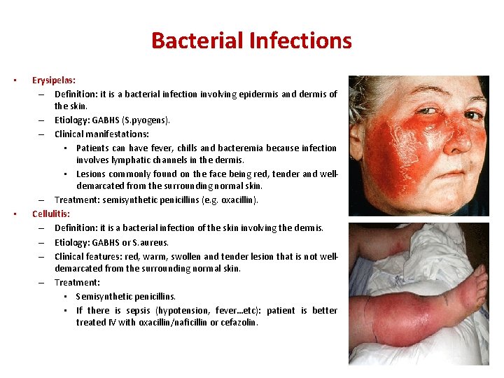 Bacterial Infections • • Erysipelas: – Definition: it is a bacterial infection involving epidermis