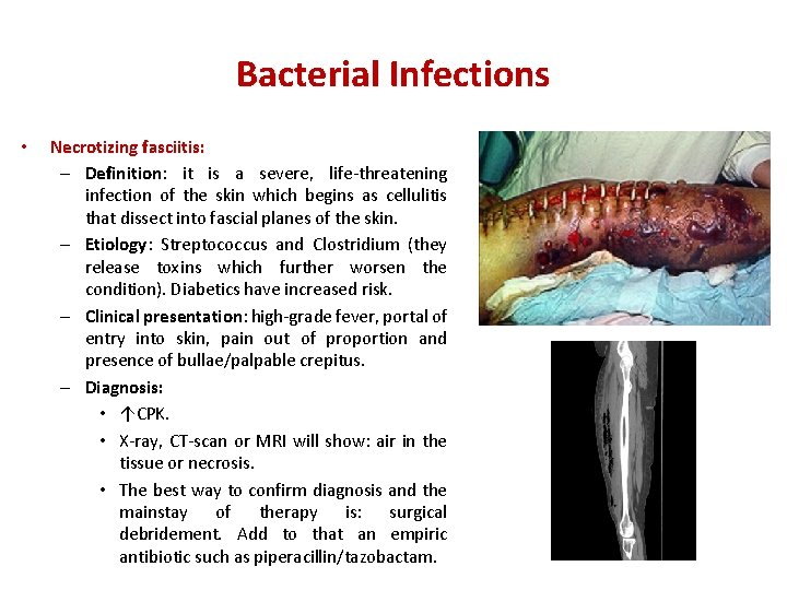 Bacterial Infections • Necrotizing fasciitis: – Definition: it is a severe, life-threatening infection of