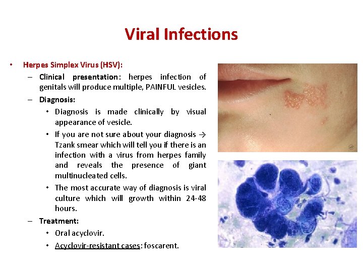 Viral Infections • Herpes Simplex Virus (HSV): – Clinical presentation: herpes infection of genitals