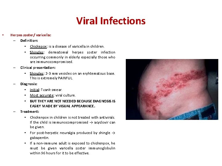 Viral Infections • Herpes zoster/ varicella: – Definition: • Chickepox: is a disease of