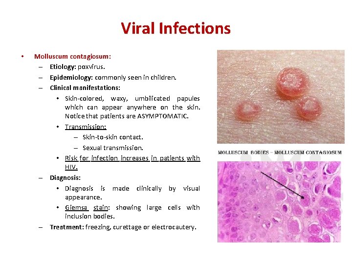 Viral Infections • Molluscum contagiosum: – Etiology: poxvirus. – Epidemiology: commonly seen in children.