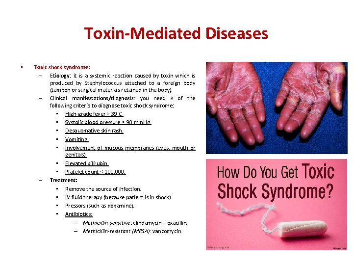 Toxin-Mediated Diseases • Toxic shock syndrome: – Etiology: it is a systemic reaction caused