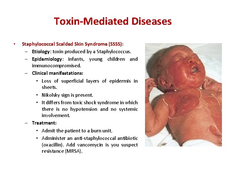 Toxin-Mediated Diseases • Staphylococcal Scalded Skin Syndrome (SSSS): – Etiology: toxin produced by a