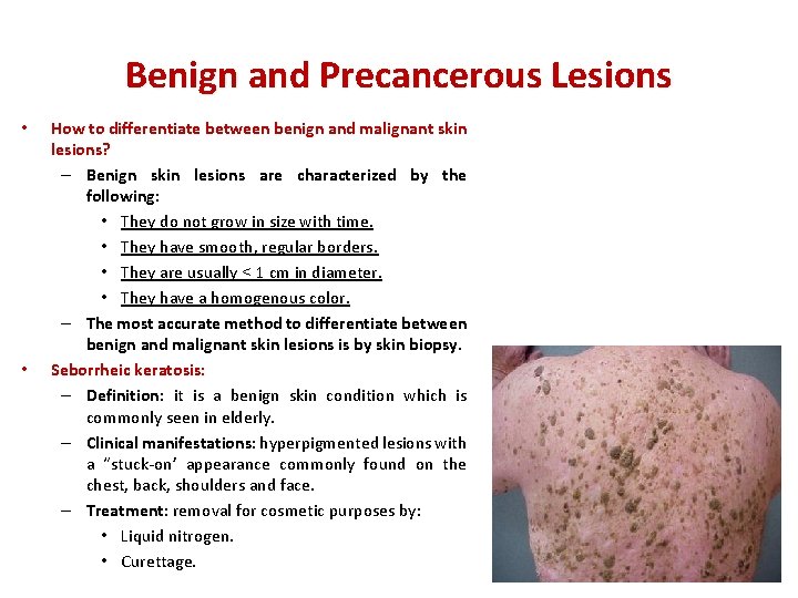 Benign and Precancerous Lesions • • How to differentiate between benign and malignant skin