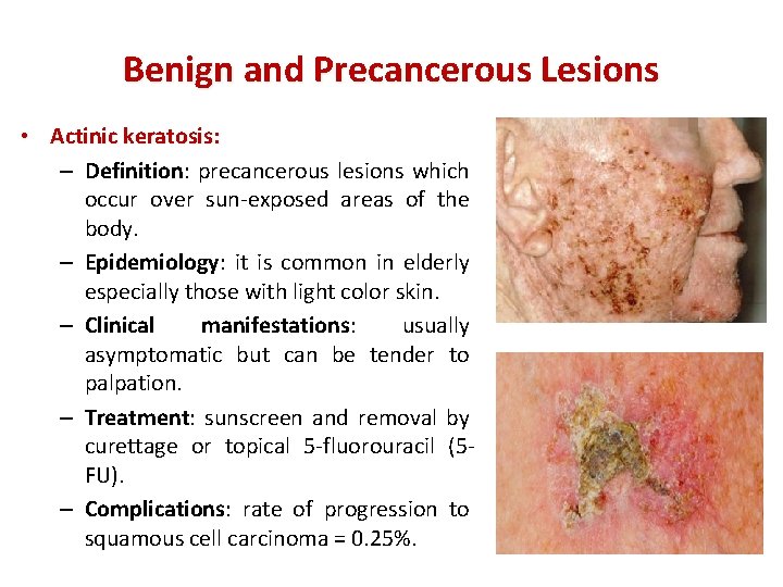 Benign and Precancerous Lesions • Actinic keratosis: – Definition: precancerous lesions which occur over