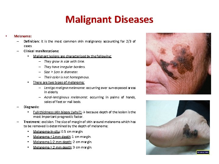 Malignant Diseases • Melanoma: – Definition: it is the most common skin malignancy accounting