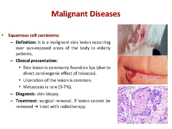 Malignant Diseases • Squamous cell carcinoma: – Definition: it is a malignant skin lesion