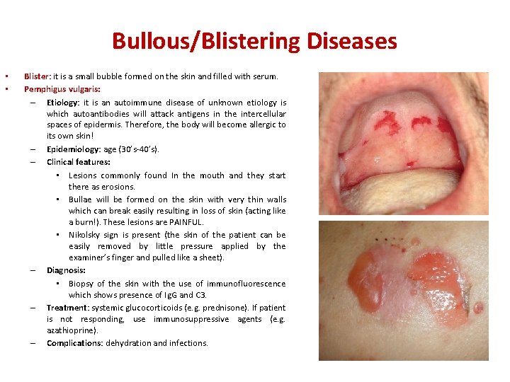 Bullous/Blistering Diseases • • Blister: Blister it is a small bubble formed on the