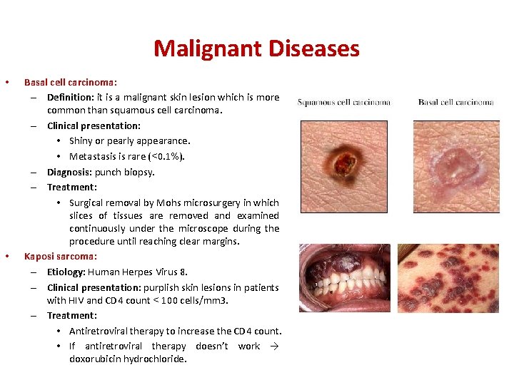 Malignant Diseases • • Basal cell carcinoma: – Definition: it is a malignant skin