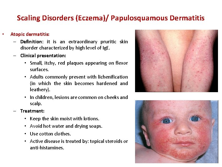 Scaling Disorders (Eczema)/ Papulosquamous Dermatitis • Atopic dermatitis: – Definition: it is an extraordinary