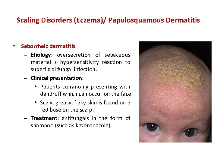 Scaling Disorders (Eczema)/ Papulosquamous Dermatitis • Seborrheic dermatitis: – Etiology: oversecretion of sebaceous material