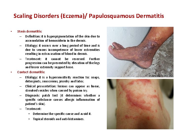 Scaling Disorders (Eczema)/ Papulosquamous Dermatitis • • Stasis dermatitis: – Definition: it is hyperpigmentation