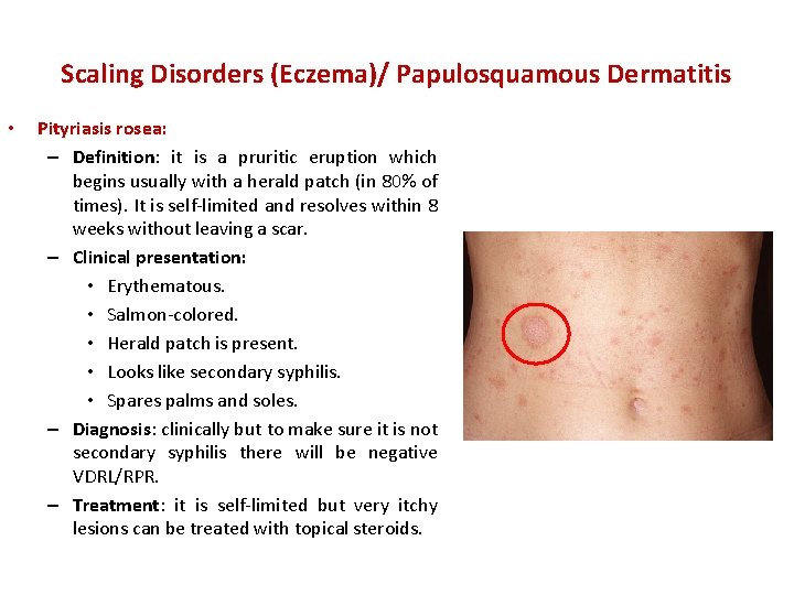 Scaling Disorders (Eczema)/ Papulosquamous Dermatitis • Pityriasis rosea: – Definition: it is a pruritic