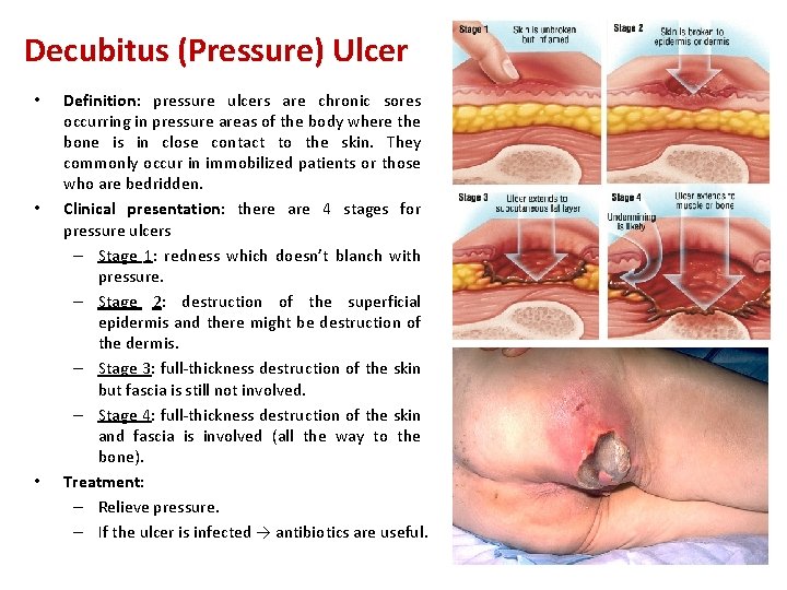 Decubitus (Pressure) Ulcer • • • Definition: pressure ulcers are chronic sores occurring in