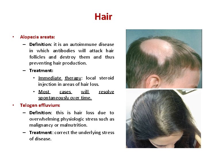 Hair • • Alopecia areata: – Definition: it is an autoimmune disease in which